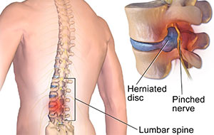 Lumbar Spine Herniation
