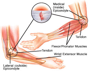 Medial Epicondylitis - Golfer Elbow