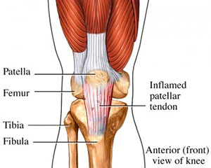 Patella Tendonitis/OSIS (Jumper's Knee)