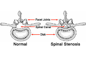 Stenosis of the spine